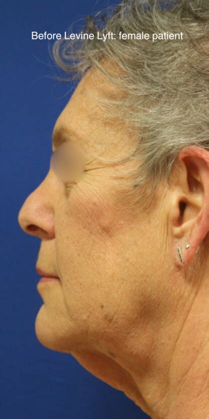 Patient 15098 Facelift Neck Lift Before And After Photos New York