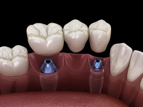 The 3 Main Types Of Dental Implant Restorations