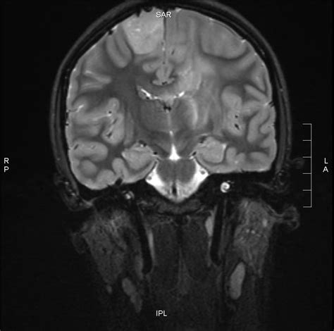 Types Of Brain Tumor – Answers To All Types Of Questions | TypesOf.com