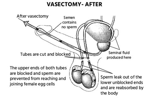 Vasectomy Reversal Cost Preparation Surgeons And Benefits