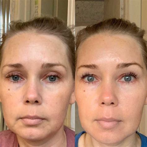 Tretinoin Cream Before And After Acne