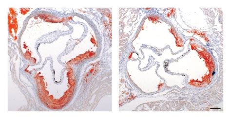 Metoprolol Decreases Atherosclerosis A B Metoprolol Treatment