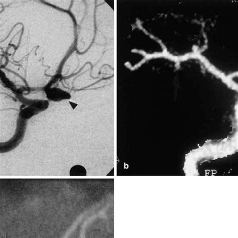 A Intra Arterial Digital Subtraction Angiography Iadsa Frontal Per Download Scientific