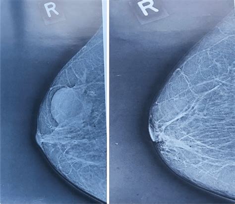 Mammography Flashcards Quizlet