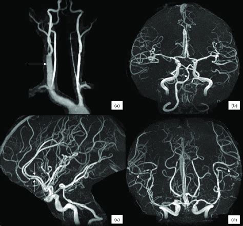 A To D Magnetic Resonance Angiography MRA Showing A Aneurysmal