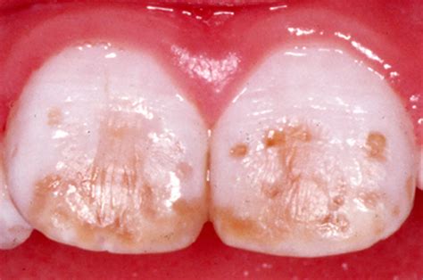 Dental fluorosis causes, prevention, symptoms & dental fluorosis treatment