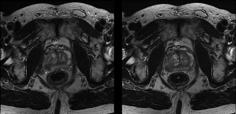 Deep Learning Accelerated T2 Weighted Imaging Of The Prostate