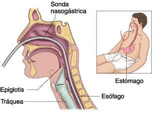 discapacidademotora blogspot SONDA NASOGÁSTRICA