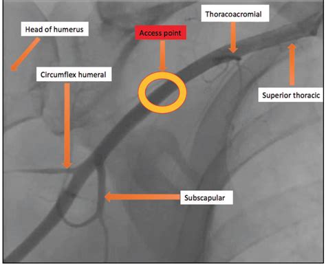 Left Axillary Artery