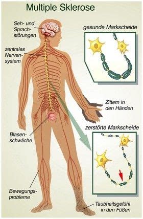 Pin Auf Medizin Krankheitsbilder