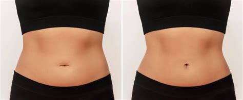 L Abdominoplastie En Tunisie R Ussir Votre Voyage Vers Un Ventre Plat