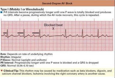 Ch Heart Block Dysrhythmias Flashcards Quizlet