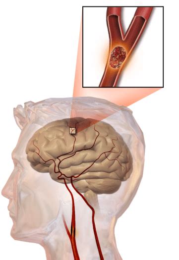 Difference Between Stroke And Tia Signs And Symptoms Causes Risk Factors Diagnosis Treatment