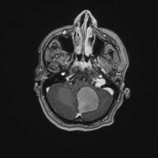 T1 Axial Weighted Magnetic Resonance Imaging With Contrast