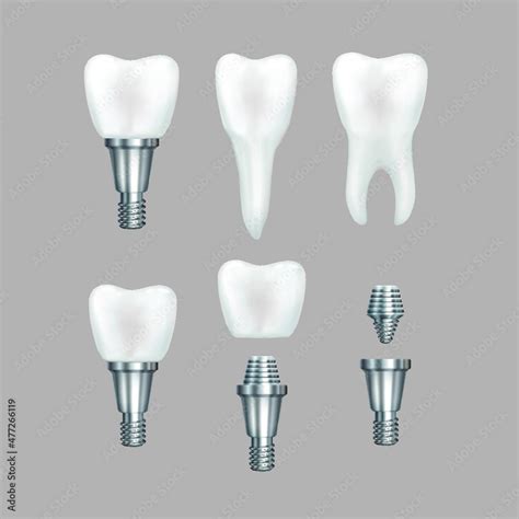 Teeth Maquette Structural Elements Of Dental Implant Infographic For