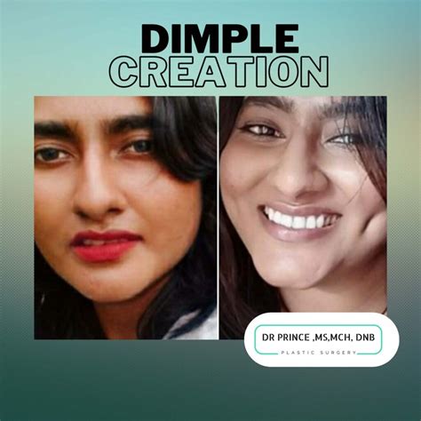 Dimple creation - topplasticsurgery