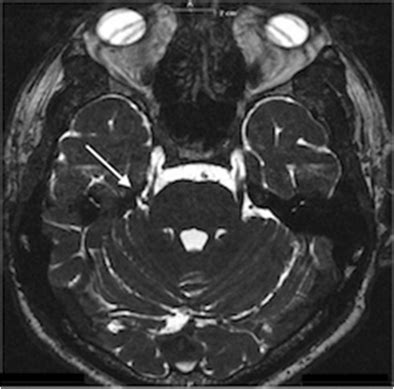 T2 DRIVE MRI Sequences Axial Section Showing The Vascular Loop Around