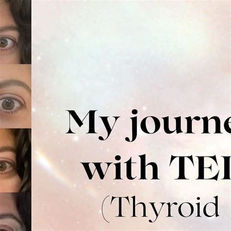 My TED progression : r/ThyroidEyeDisease