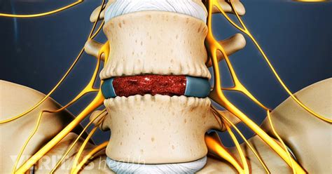 Bone Graft Substitutes