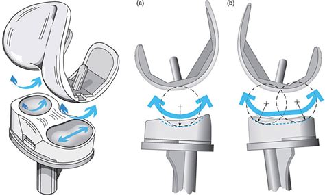 Pros And Cons Of Different Types Of Knee Implants Dr Kurtz — Nashville Joint Replacement