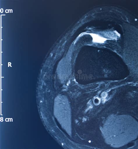 Knee injury mri mcl tear stock photo. Image of diagnosis - 162393618