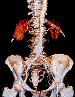 Fillable Online Ast Abdominal Aortic Aneurysm Repair Ast Fax