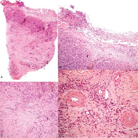 A C Histopathologic Features Of Venous Ulcers Ulcer And Hyperplasia