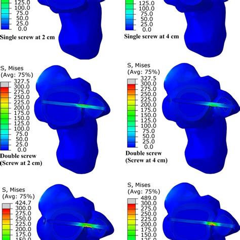 The Maximum Von Mises Stress On Screws In Different Fixation Models Download Scientific Diagram