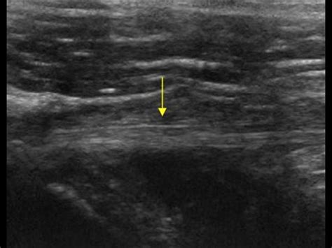 Musculoskeletal Joints and Tendons | 6.1 Shoulder : Case 6.1.3 Biceps tendon instability ...