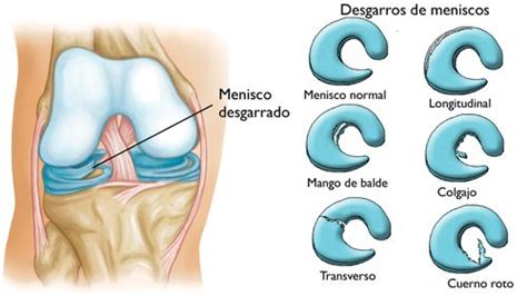 Lesiones De La Rodilla Ligamentos Y Meniscos Osium Trauma