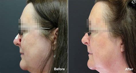 Reconstructive Surgery Photos Princeton Nj Patient 9865