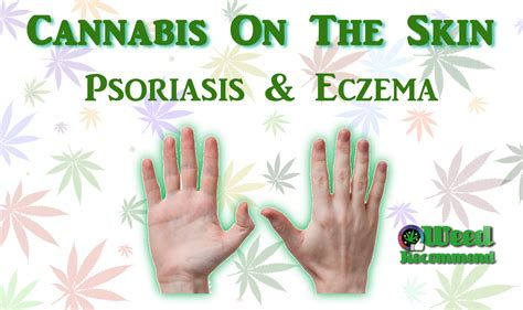 Cannabis On The Skin Psoriasis And Eczema Weed Recommend