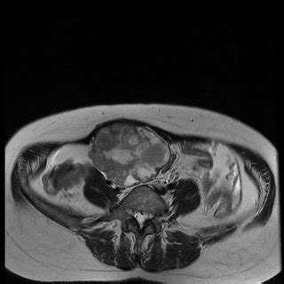 Axial T Weighted Spin Echo Image Demonstrates A Multinodular Complex