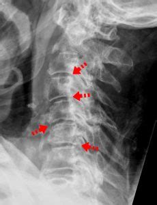 Artrosi Cervicale Sintomi E Cura Guida Avanzata Ryakos