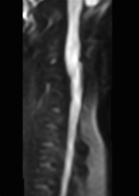 Total Spine On A 14 Year Old Patient Philips Mr Body Map