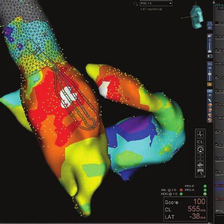 High Density Mapping Performed With The Advisor Hd Grid Catheter In