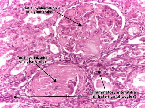 Kidney Disease Histology