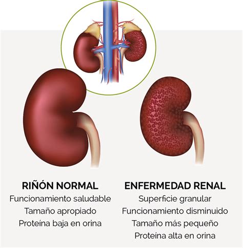 Equilibrio Renal NEFROPATÍA DIABÉTICA