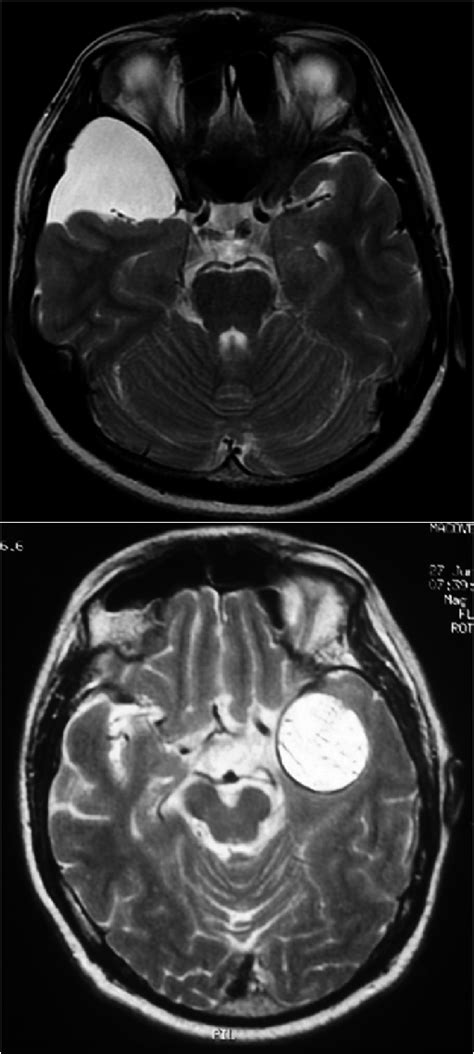 Intra Cranial Cyst Arachnoid Cyst Vs Epidermoid Cyst Vs Dermoid Cyst