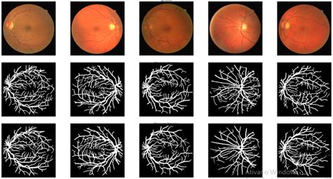 GitHub Julio M39 10 Segmentation Of Retina Vessels