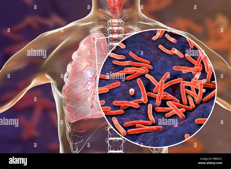 La Tuberculose Et Infection Secondaire Vue Rapprochée De La Bactérie