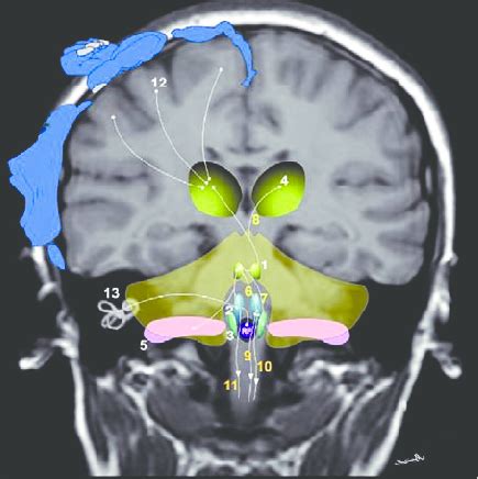 Schematic View Superimposed On Coronal Mr Image Of The Vestibular