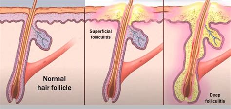 Hot Tub Folliculitis Causes Prevention And Treatment