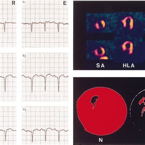 Patient From The Group With St Segment Elevation On The Precordial