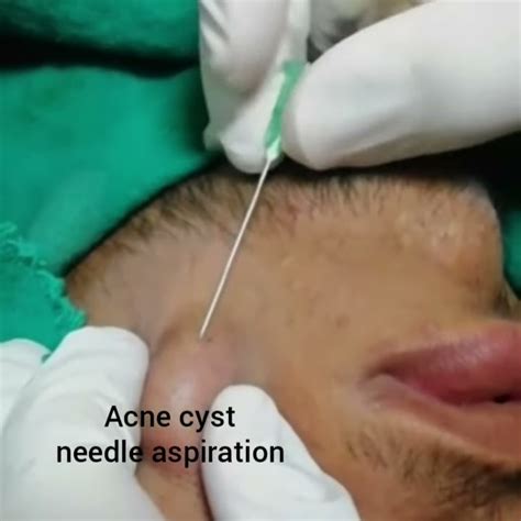 Acne Cyst Needle Aspiration Youtube