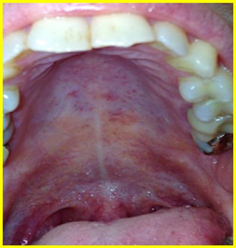 Enanthem During Meningococcal Septicemia Erythematous Macules On The