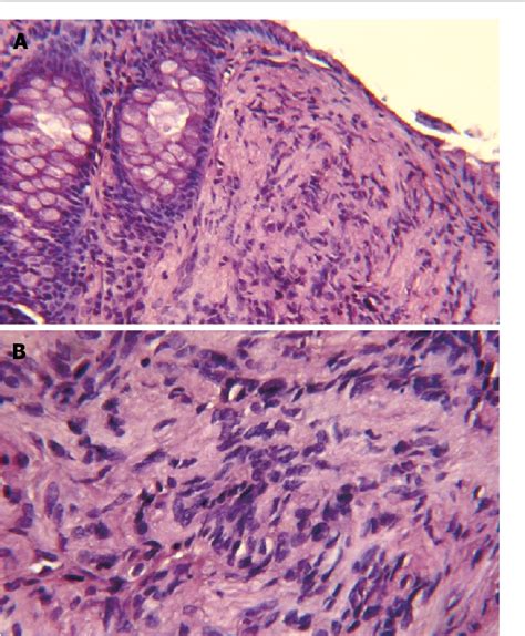 Figure From Mucosal Schwann Cell Hamartoma A New Entity