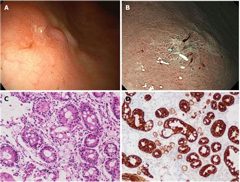 Gastric Adenocarcinoma Prognosis