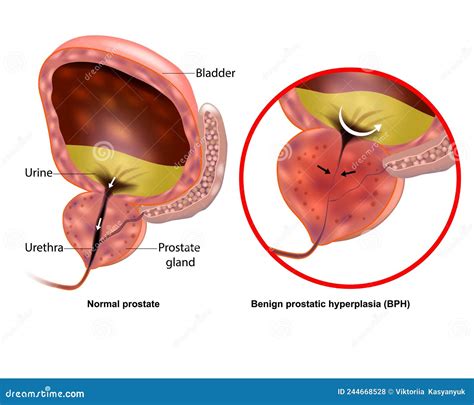 Medical Illustration Showing Benign Prostatic Hyperplasia Bph And