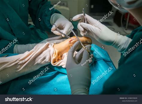 Hallux Valgus Operation Photos and Images | Shutterstock